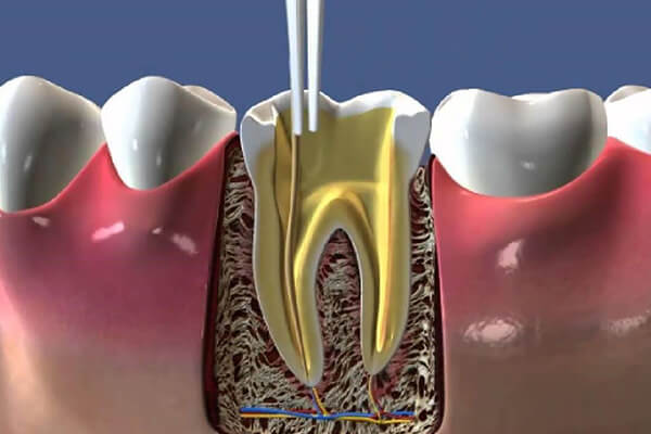 kanal tedavisi avantajları, kanal tedavisi ile diş kaybının önüne geçin, estetik kanal tedavisi