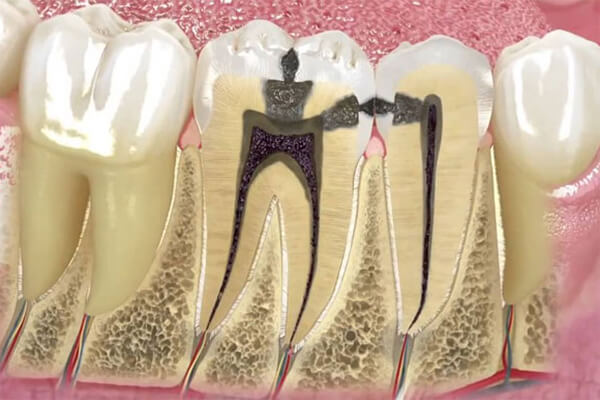 kanal tedavisi uygulaması, kanal tedavisi uygulama alanları, diş eti hastalıklarında kanal tedavisi
