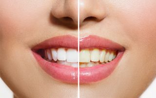 dis-beyazlatma-tedavisinden-sonra-disler-tekrar-sararir-mi-320×202 dis-beyazlatma-tedavisinden-sonra-disler-tekrar-sararir-mi-320x202