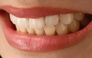 dis-gicirdatma-nedir-dis-gicirdatmanin-onuna-nasil-gecilir-320×202 dis-gicirdatma-nedir-dis-gicirdatmanin-onuna-nasil-gecilir-320x202