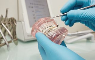 dis-teli-mi-yoksa-seffaf-plak-mi-daha-iyi-320×202 dis-teli-mi-yoksa-seffaf-plak-mi-daha-iyi-320x202