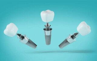 hizli-implant-nasil-yapilir-320x202