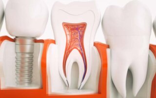 hizli-implant-tedavisi-ile-1-gunde-implant-320x202