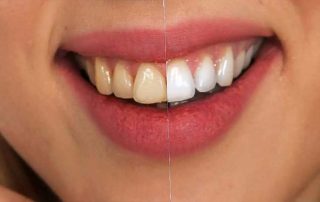 pedodontik-bir-problem-florozis-nedir-320x202