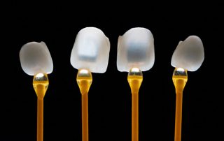 porselen-laminalarin-omru-ne-kadardir-320×202 porselen-laminalarin-omru-ne-kadardir-320x202