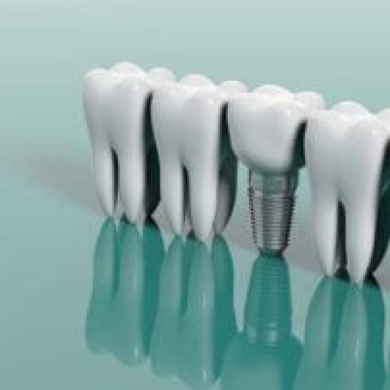 basarisiz-implant-belirtileri-iplant-islemi-basarisiz-olursa-320x202