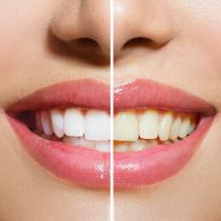 dis-beyazlatma-tedavisinden-sonra-disler-tekrar-sararir-mi-320x202