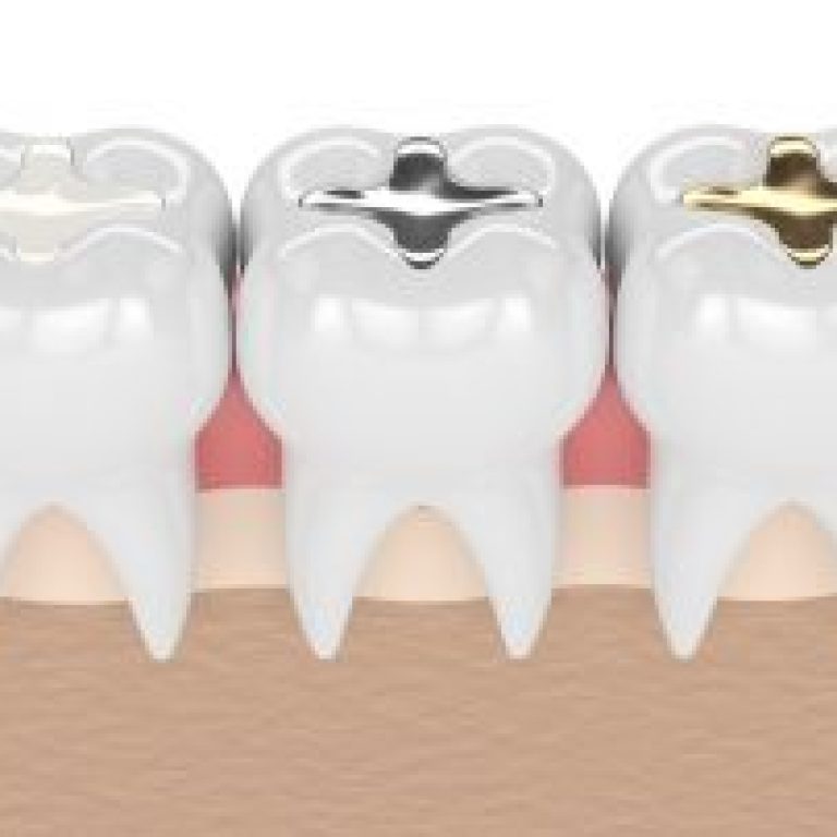 dolgulu-dis-agrisi-nasil-gecebilir-320x202