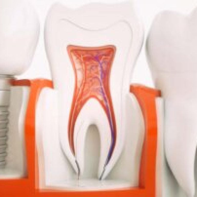 hizli-implant-tedavisi-ile-1-gunde-implant-320x202