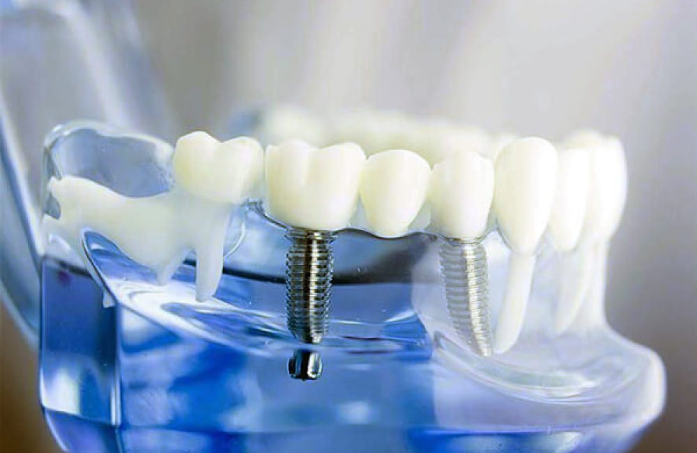 implant-tedavisi-uygulamasi implant-tedavisi-uygulamasi
