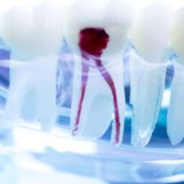 kanal-tedavisi-nasil-yapilir-nelere-dikkat-etmek-gerekir-320x202