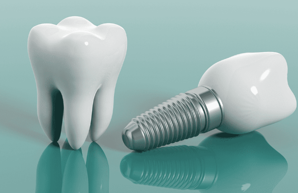 nisantasi-implant-tedavisi nisantasi-implant-tedavisi