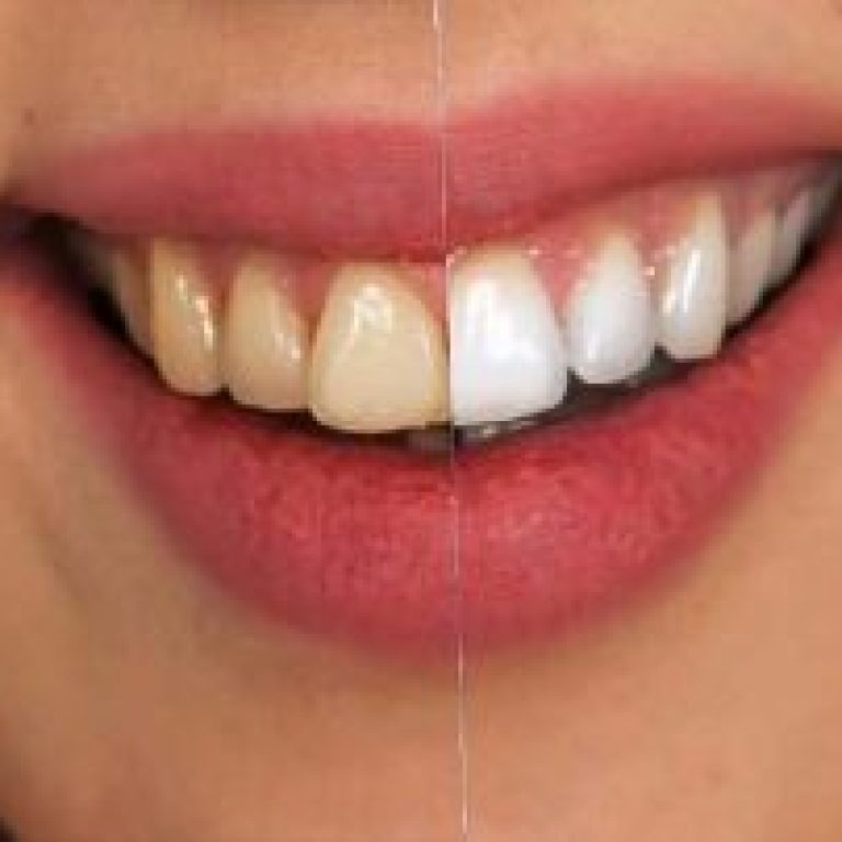 pedodontik-bir-problem-florozis-nedir-320x202